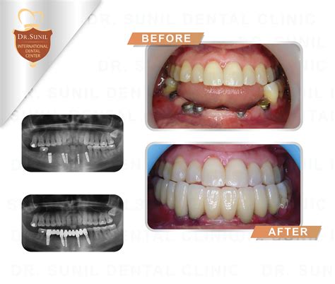 How to Choose the Best Clinic for Dental Implants in Thailand .